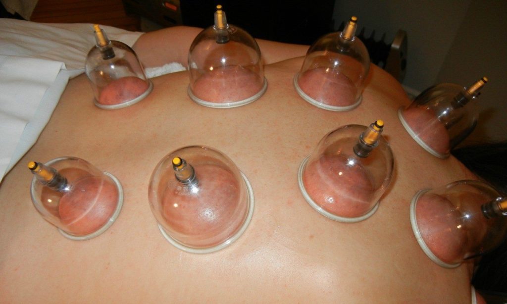 Cupping Therapy